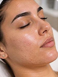 HydraFacial Before